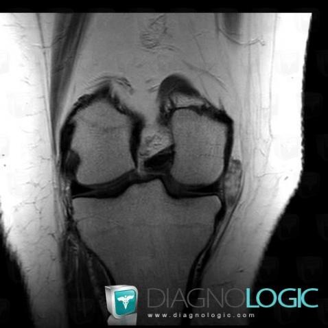 Hemangioma, Other soft tissues/nerves - Knee, MRI