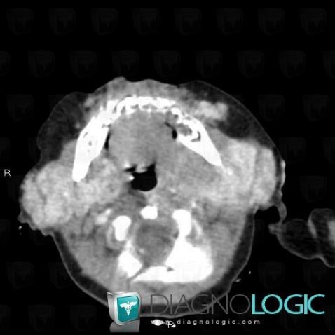 Hemangioma, Parotid and other salivary glands, CT