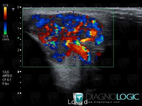 Hemangioma, Parotid and other salivary glands, US