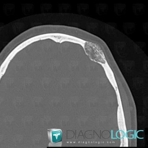 Hemangioma, Skull vault, CT