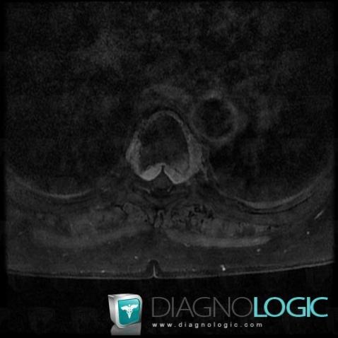 Hemangioma, Spinal canal / Cord, MRI