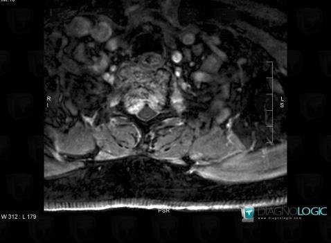 Hemangioma, Spinal canal / Cord, MRI