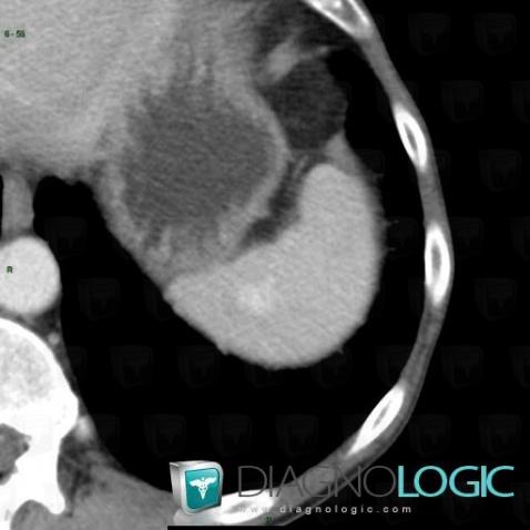 Hemangioma, Spleen, CT