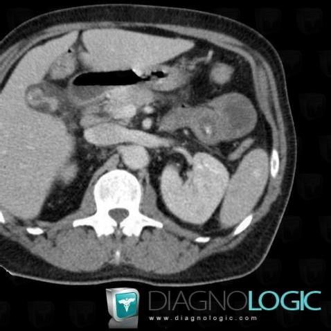 Hemangioma, Spleen, CT