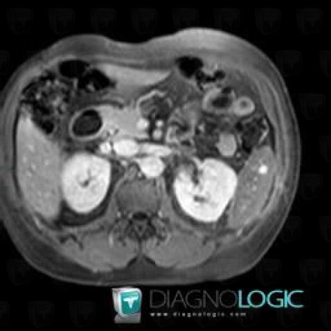 Hemangioma, Spleen, MRI