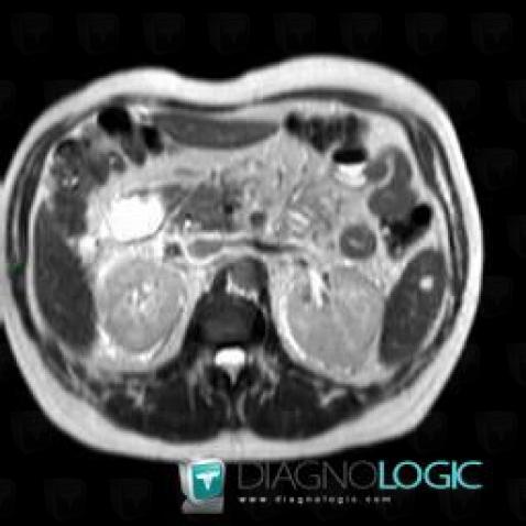 Hemangioma, Spleen, MRI