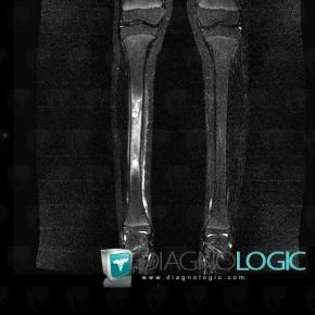 Hemangioma, Tibia - Mid part, MRI
