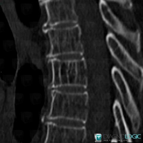 Hemangioma, Vertebral body / Disk, CT