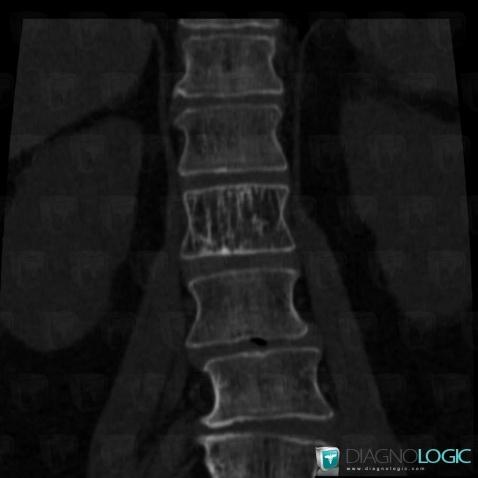 Hemangioma, Vertebral body / Disk, CT