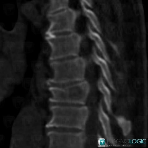 Hemangioma, Vertebral body / Disk, CT