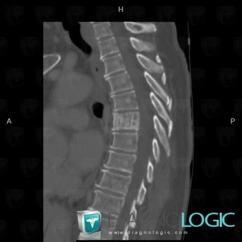 Hemangioma, Vertebral body / Disk, CT