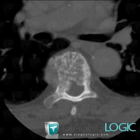 Hemangioma, Vertebral body / Disk, CT