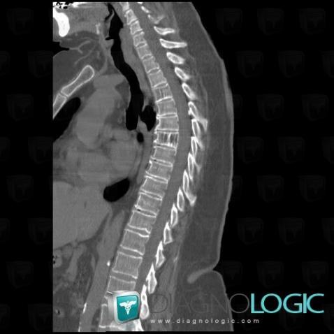 Hemangioma, Vertebral body / Disk, CT