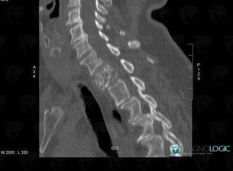 Hemangioma, Vertebral body / Disk, CT