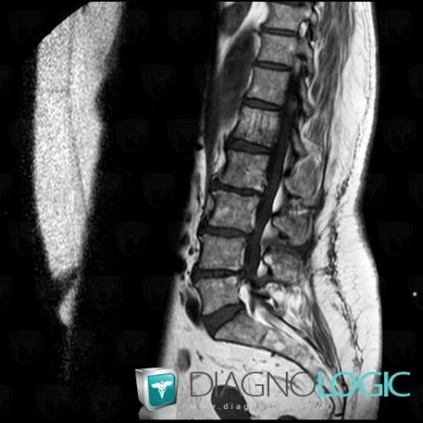 Hemangioma, Vertebral body / Disk, MRI