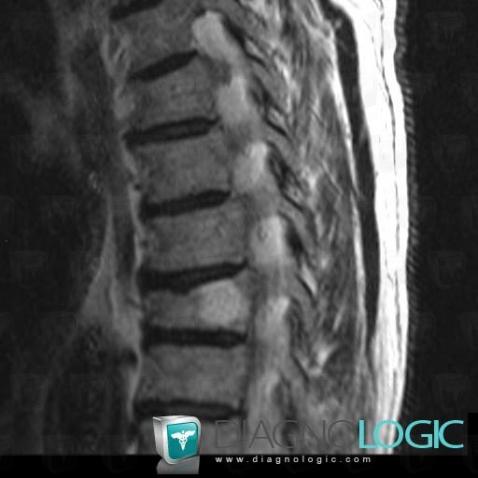 Hemangioma, Vertebral body / Disk, MRI