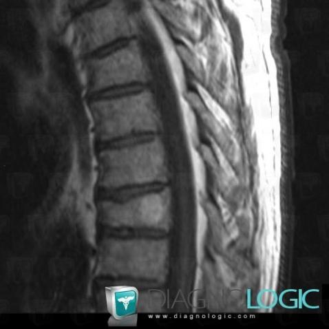 Hemangioma, Vertebral body / Disk, MRI