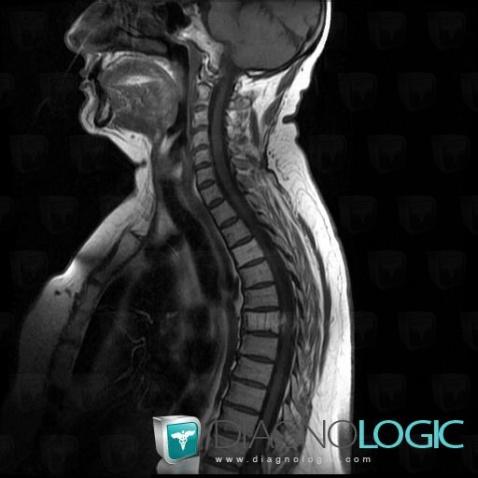 Hemangioma, Vertebral body / Disk, MRI