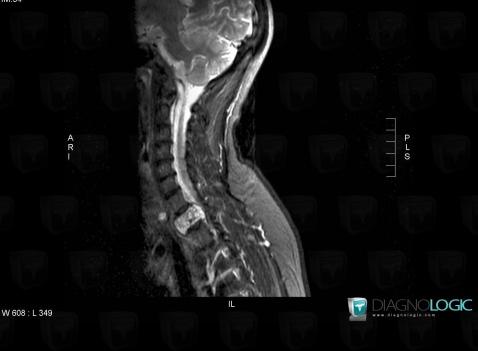 Hemangioma, Vertebral body / Disk, MRI