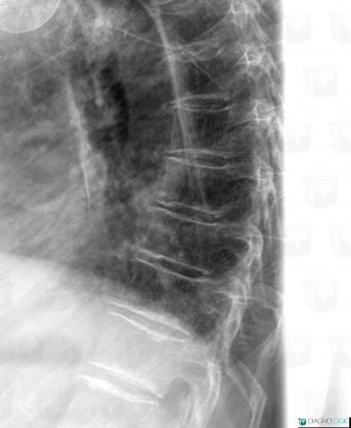 Hemangioma, Vertebral body / Disk, X rays