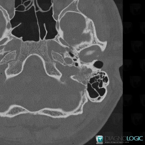 Hemangioma, VII VIII nerves, Temporal bone, CT