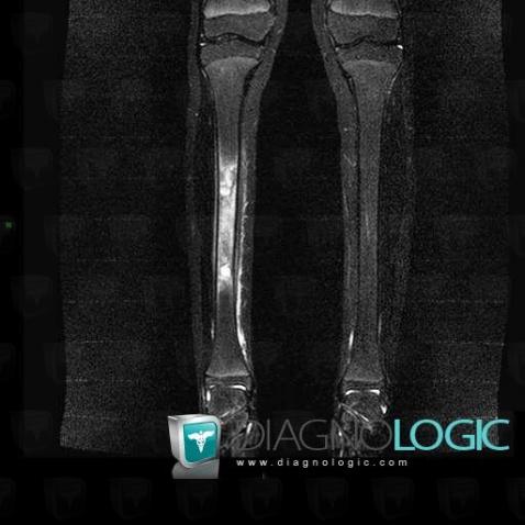 Hémangiome , Tibia -moyen, IRM