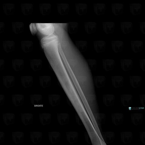 Hémangiome , Tibia -moyen, Radio