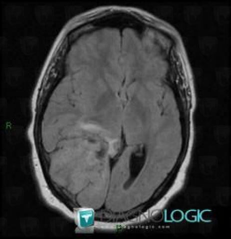 Hemangiopericytoma, Cerebral hemispheres, MRI