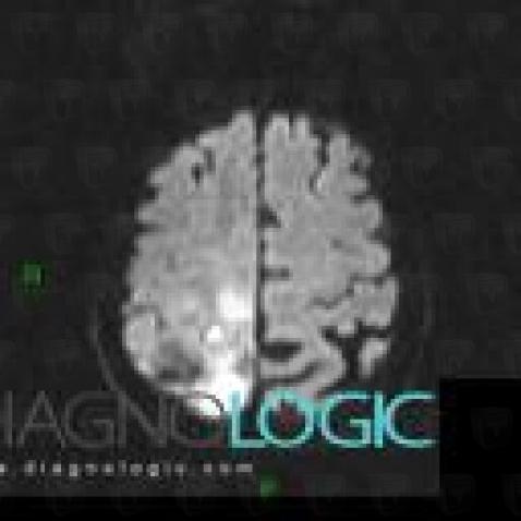 Hemangiopericytoma, Cerebral hemispheres, MRI