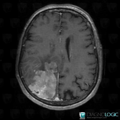 Hemangiopericytoma, Cerebral hemispheres, MRI