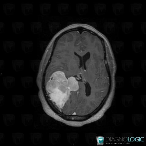 Hemangiopericytoma, Supratentorial peri cerebral spaces, Cerebral hemispheres, MRI