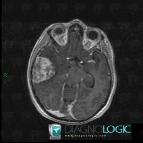 Hemangiopericytoma, Supratentorial peri cerebral spaces, Cerebral hemispheres, MRI