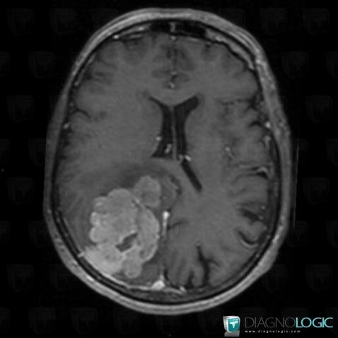 Hemangiopericytoma, Supratentorial peri cerebral spaces, MRI