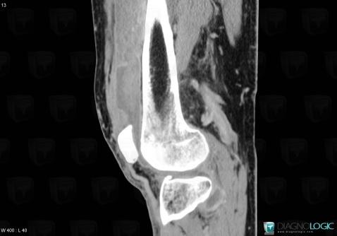 Hemarthrosis, Femorotibial joints - Intercondylar notch, CT