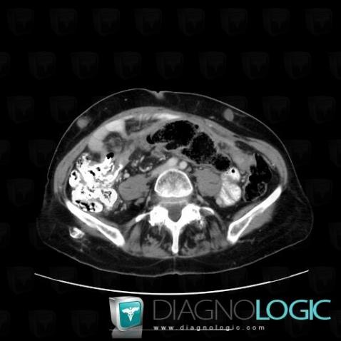 Hematoma, Abdominal wall, CT