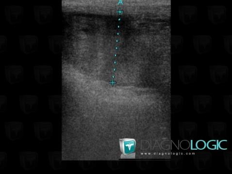 Hematoma, Abdominal wall, US