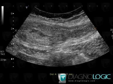 Hematoma, Abdominal wall, US