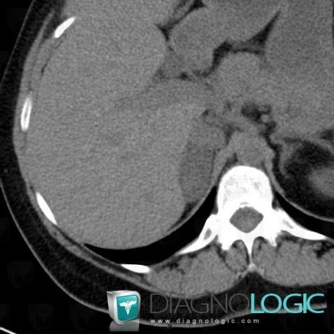 Hematoma, Adrenal glands, CT