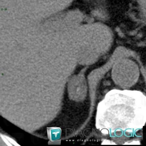 Hematoma, Adrenal glands, CT