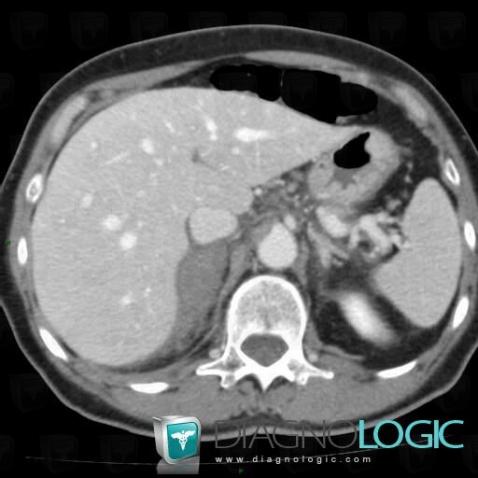 Hematoma, Adrenal glands, CT