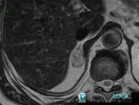 Hematoma, Adrenal glands, MRI