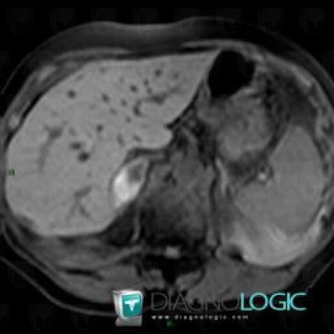 Hematoma, Adrenal glands, MRI