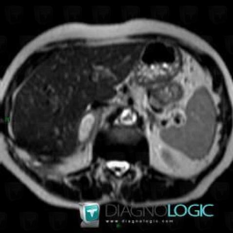 Hematoma, Adrenal glands, MRI