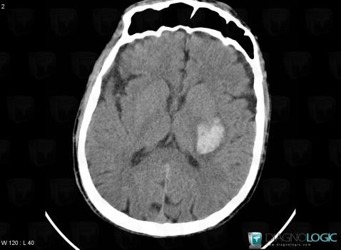 Hematoma, Basal ganglia and capsule, CT