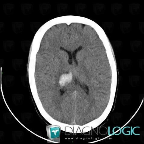 Hematoma, Basal ganglia and capsule, CT