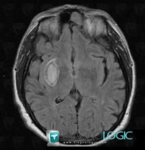 Hematoma, Basal ganglia and capsule, MRI