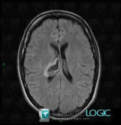 Hematoma, Basal ganglia and capsule, MRI