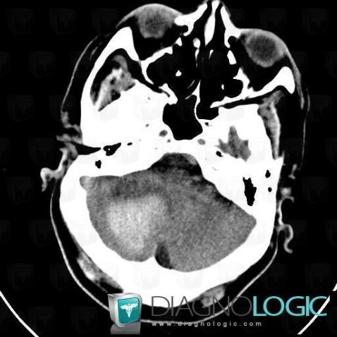 Hematoma, Cerebellar hemisphere, Posterior fossa, CT