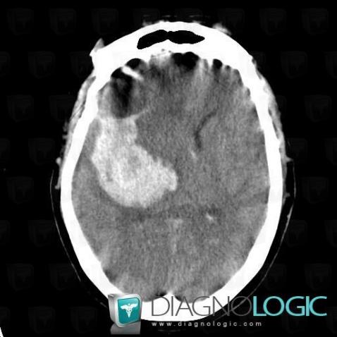 Hematoma, Cerebral hemispheres, CT