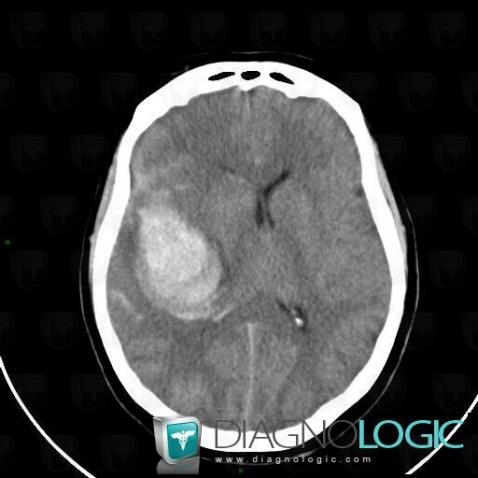 Hematoma, Cerebral hemispheres, CT